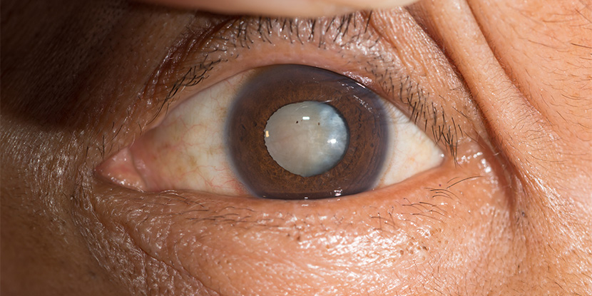 Cataract Appearance in Old People