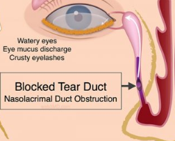nasolacrimal duct obstruction